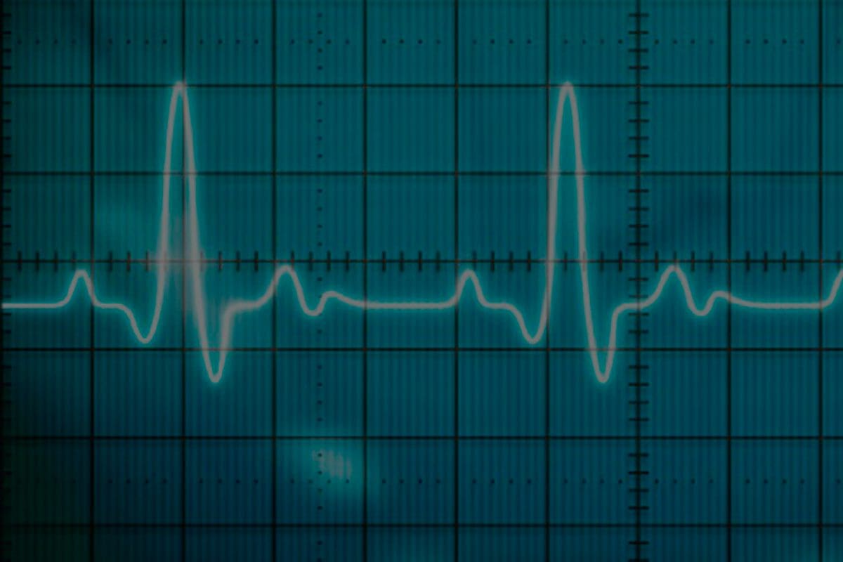 El Punto J en el Electrocardiograma de Superficie – Dr. Héctor Barajas Martínez
